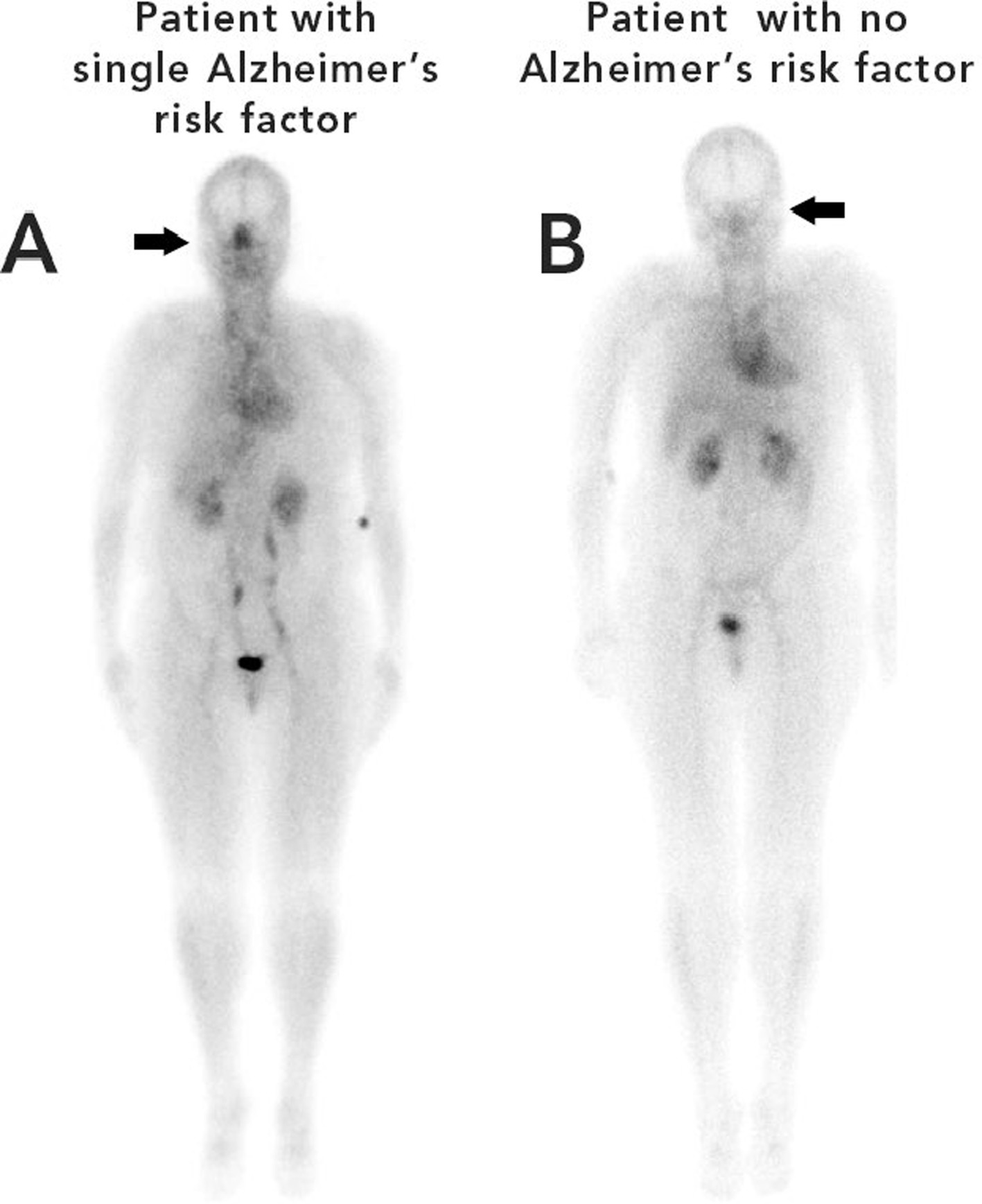 Nasal lymphatic obstruction of CSF drainage as a possible cause of Alzheimer’s disease and dementia